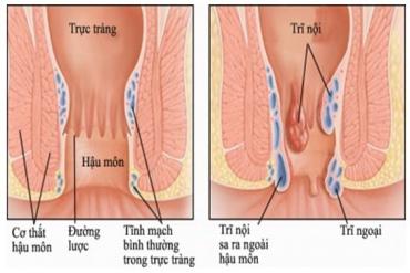 Hướng dẫn giáo dục bệnh lí trĩ