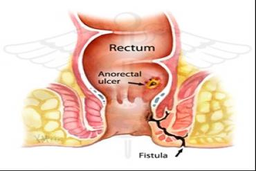 Những kiến thức về rò hậu môn