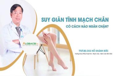 Suy giãn tĩnh mạch chân có cách nào ngăn chặn?