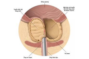 Bóc nhân tuyến tiền liệt bằng Laser Holmium (HoLep) trong điều trị bướu lành tuyến tiền liệt thể tích lớn