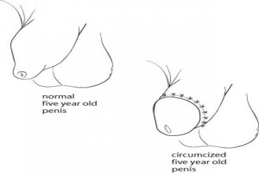 Làm gì khi trẻ nhỏ bị hẹp bao quy đầu?