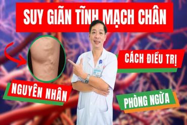 Giải đáp 10 thắc mắc thường gặp về suy giãn tĩnh mạch chân